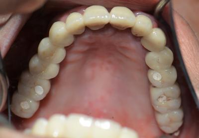 Implant dentaire Perpignan